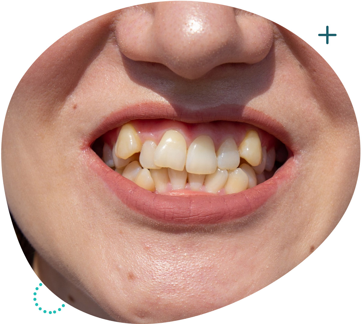 misaligned-teeth